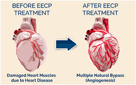 eecp treatment for cvd